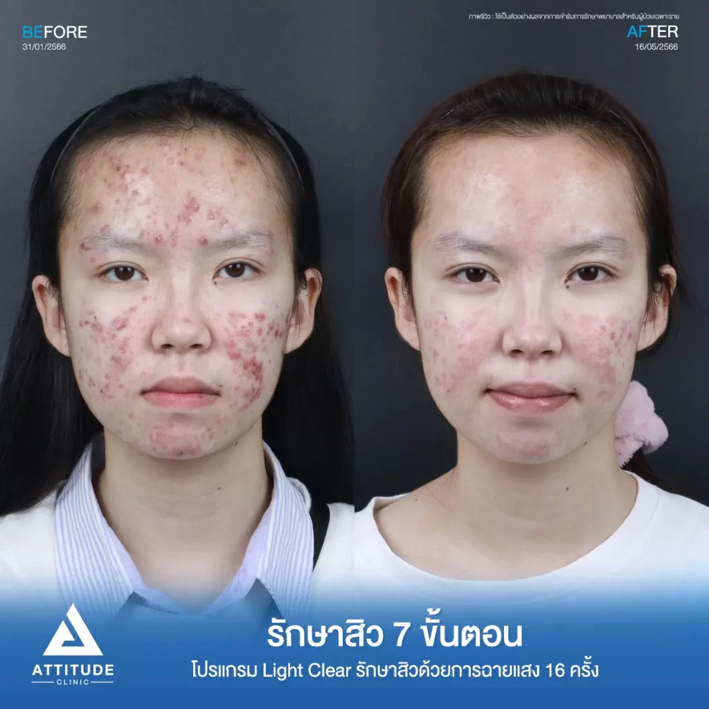 รวมรีวิวรักษาสิวอักเสบ ที่หลายคนเคยคิดว่า... "สิวแบบนี้รักษายาก"