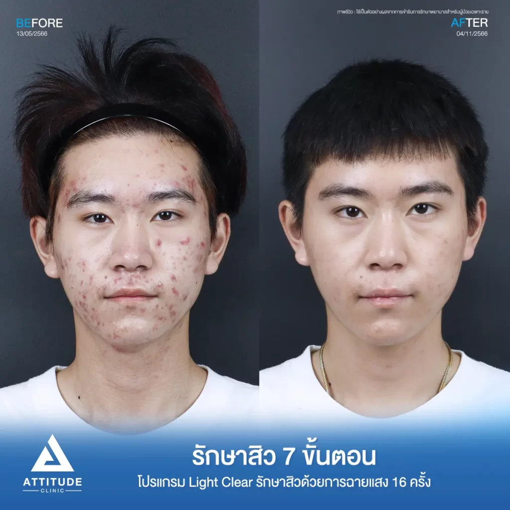รวมรีวิวรักษาสิวอักเสบ ที่หลายคนเคยคิดว่า... "สิวแบบนี้รักษายาก"
