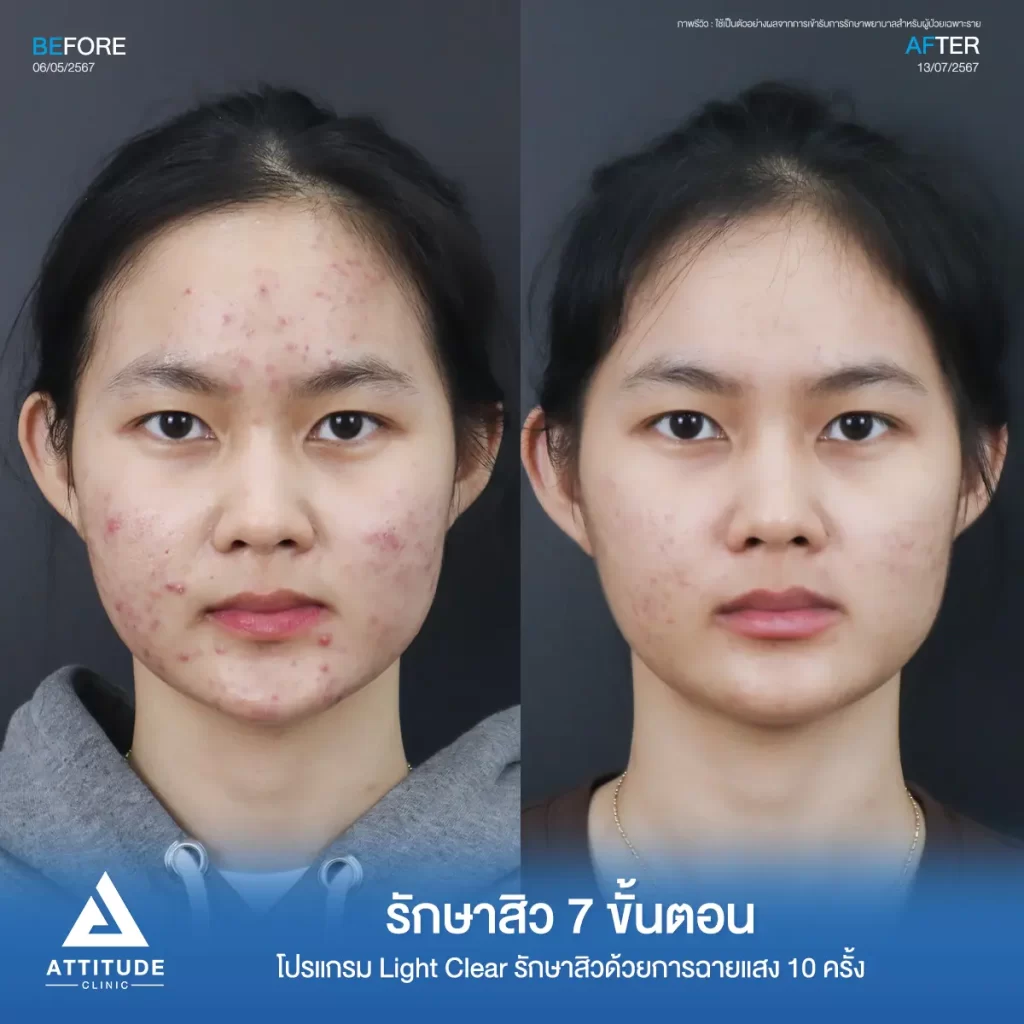 รวมรีวิวรักษาสิวอักเสบ ที่หลายคนเคยคิดว่า... "สิวแบบนี้รักษายาก"