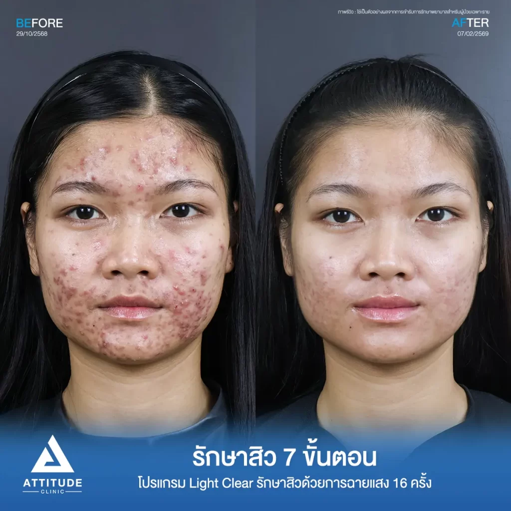 รวมรีวิวรักษาสิวอักเสบ ที่หลายคนเคยคิดว่า... "สิวแบบนี้รักษายาก"