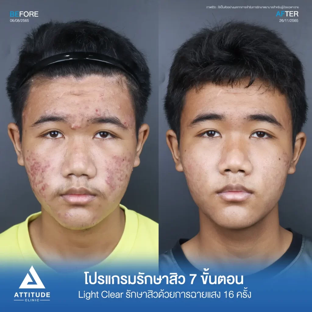 รวมรีวิวรักษาสิวอักเสบ ที่หลายคนเคยคิดว่า... "สิวแบบนี้รักษายาก"