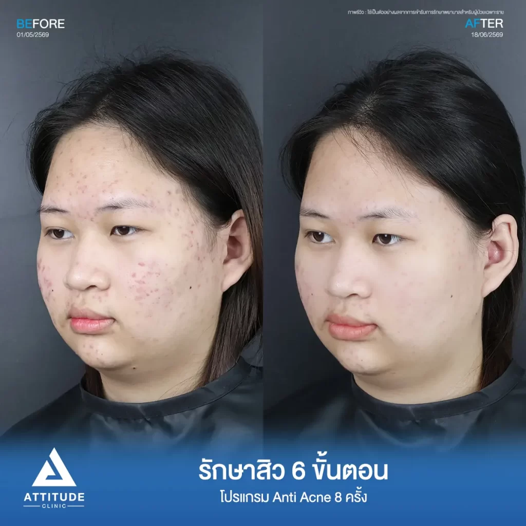 รีวิวรักษาสิวพี่ปลายอ้อ โปรแกรม Anti Acne 6 ขั้นตอน จำนวน 8 ครั้งที่ Attitude Clinic