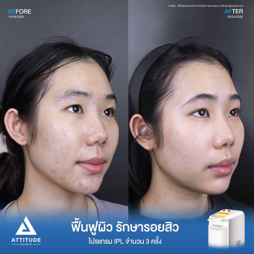 รีวิวรักษารอยสิวพี่ปอ โปรแกรม IPL จำนวน 3 ครั้งที่ Attitude Clinic