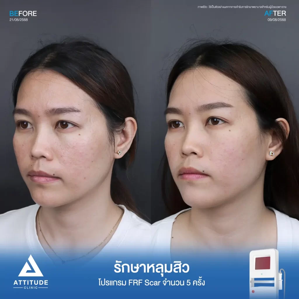 รีวิวรักษาหลุมสิวพี่โบว์ โปรแกรม FRF Scar จำนวน 5 ครั้งที่ Attitude Clinic