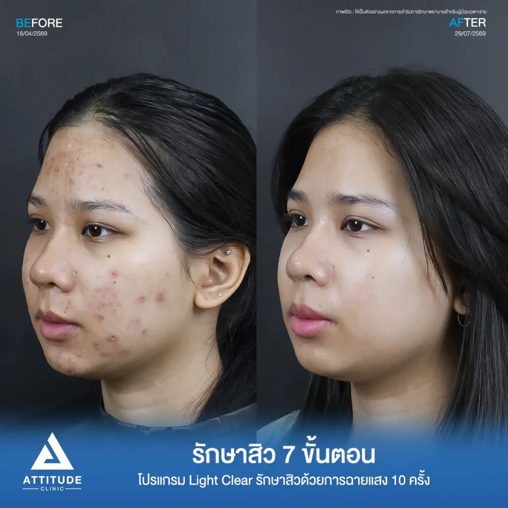รีวิวรักษาสิวพี่อาย โปรแกรม Light Clear รักษาสิวด้วยการฉายแสง จำนวน 10 ครั้งที่ Attitude Clinic