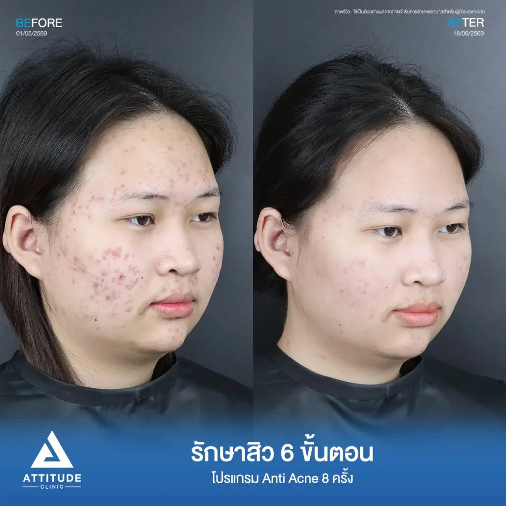 รีวิวรักษาสิวพี่ปลายอ้อ โปรแกรม Anti Acne 6 ขั้นตอน จำนวน 8 ครั้งที่ Attitude Clinic