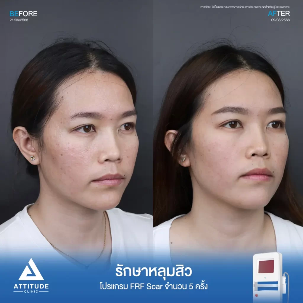 รีวิวรักษาหลุมสิวพี่โบว์ โปรแกรม FRF Scar จำนวน 5 ครั้งที่ Attitude Clinic