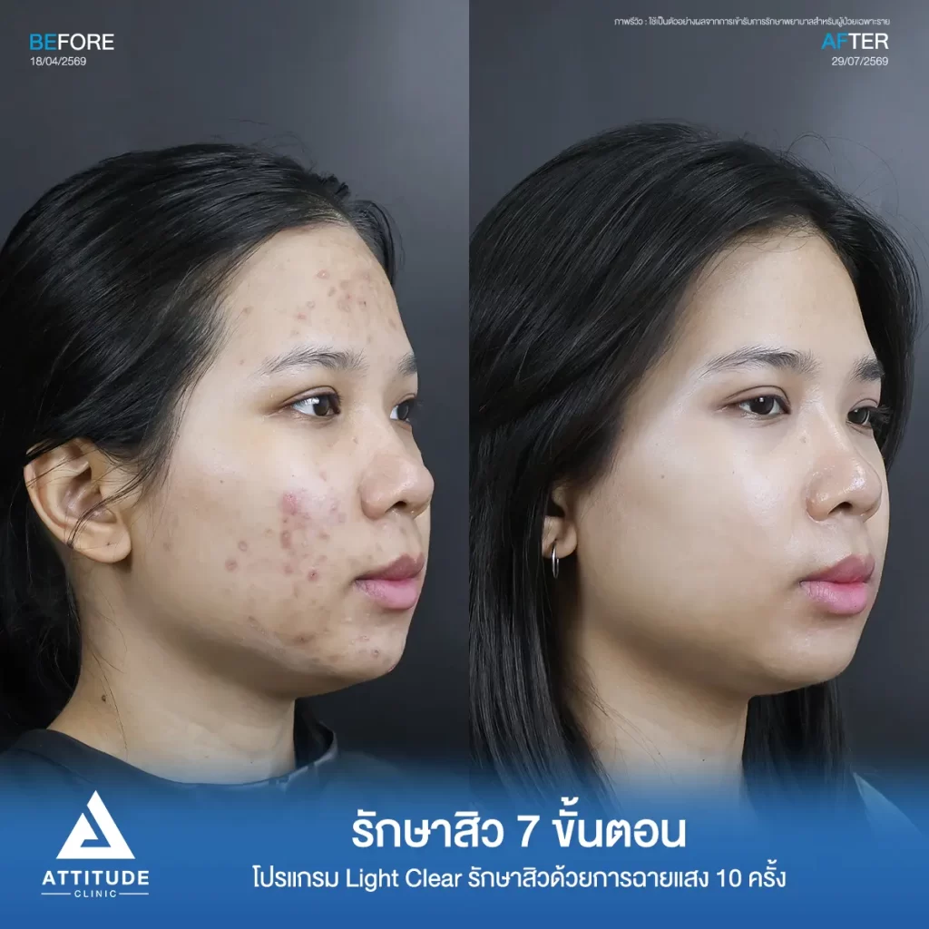 รีวิวรักษาสิวพี่อาย โปรแกรม Light Clear รักษาสิวด้วยการฉายแสง จำนวน 10 ครั้งที่ Attitude Clinic