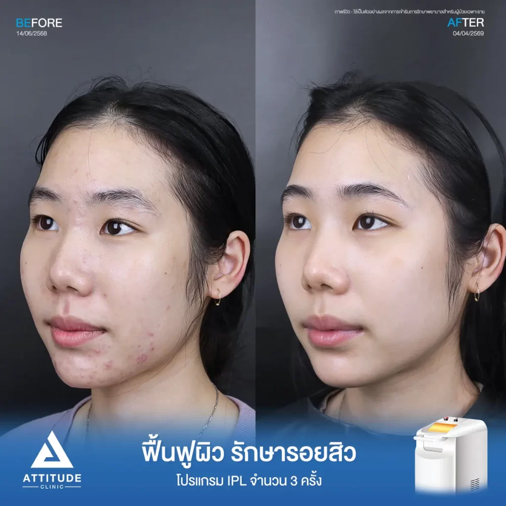 รีวิวรักษารอยสิวพี่ปอ โปรแกรม IPL จำนวน 3 ครั้งที่ Attitude Clinic