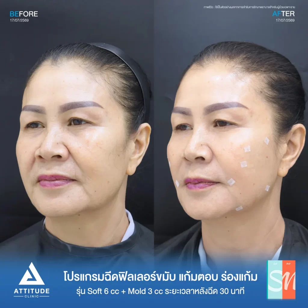 รีวิวโปรแกรมฉีดฟิลเลอร์พี่คำแดง Hya รุ่น S จำนวน 6 cc และรุ่น M จำนวน 3 cc ปรับรูปหน้า เติมร่องลึก ที่ ATTITUDE CLINIC