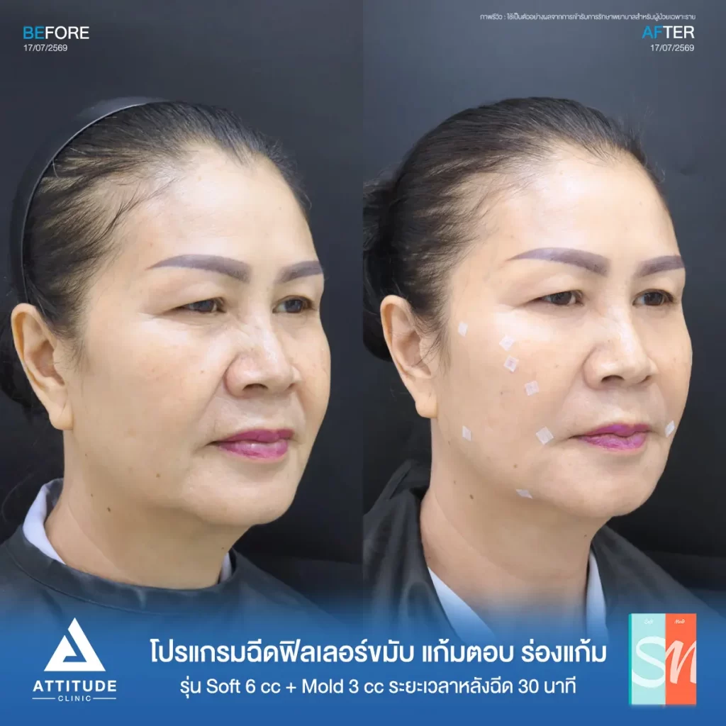 รีวิวโปรแกรมฉีดฟิลเลอร์พี่คำแดง Hya รุ่น S จำนวน 6 cc และรุ่น M จำนวน 3 cc ปรับรูปหน้า เติมร่องลึก ที่ ATTITUDE CLINIC