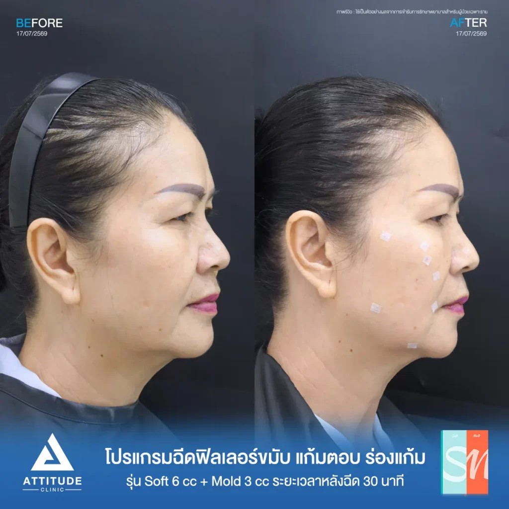 รีวิวโปรแกรมฉีดฟิลเลอร์พี่คำแดง Hya รุ่น S จำนวน 6 cc และรุ่น M จำนวน 3 cc ปรับรูปหน้า เติมร่องลึก ที่ ATTITUDE CLINIC