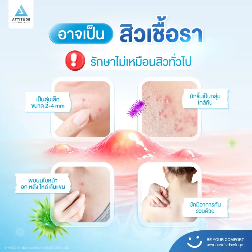 สิวกระจุกอยู่ที่เดียว ต้องระวัง! สิวแบบนี้ ไม่ใช่สิวธรรมดาทั่วไป