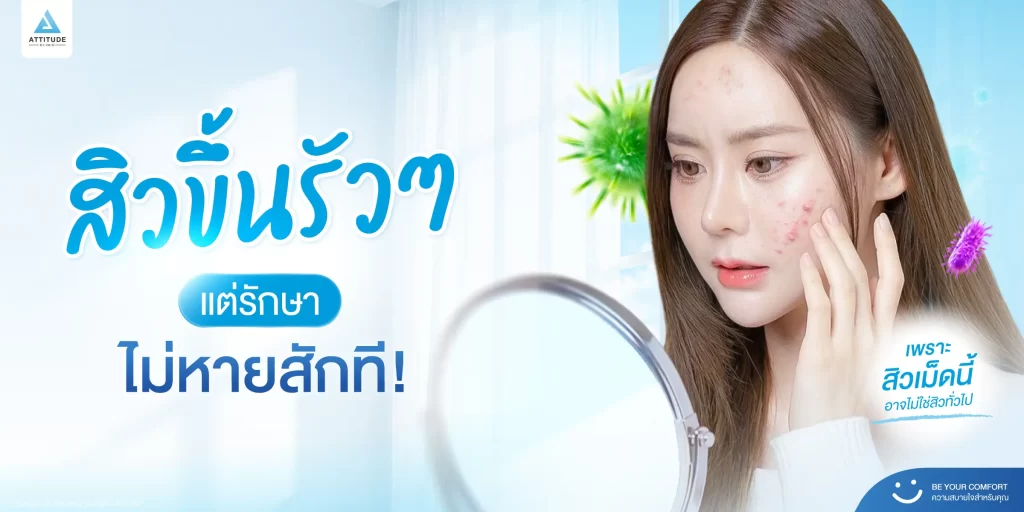 สิวกระจุกอยู่ที่เดียว ต้องระวัง! สิวแบบนี้ ไม่ใช่สิวธรรมดาทั่วไป