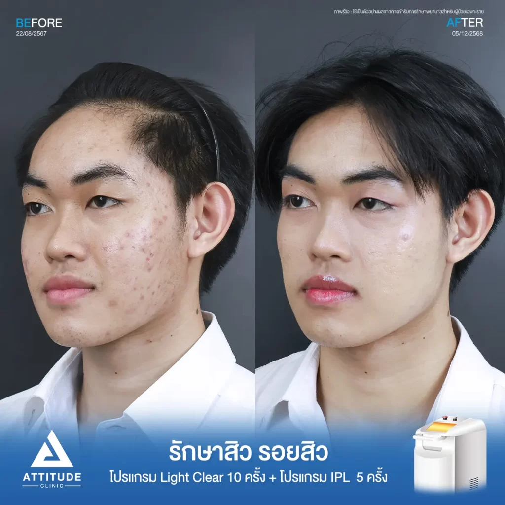 รีวิวรักษาสิวรอยสิวพี่ศุภนิมิต โปรแกรม Light Clear จำนวน 10 ครั้ง และและโปรแกรม IPL จำนวน 5 ครั้ง ที่ Attitude Clinic