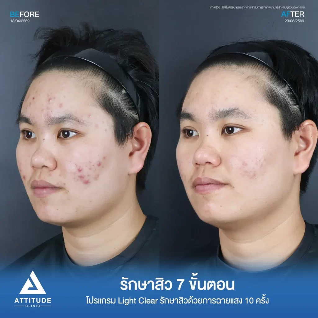รีวิวรักษาสิวพี่มีน โปรแกรม Light Clear จำนวน 10 ครั้งที่ Attitude Clinic