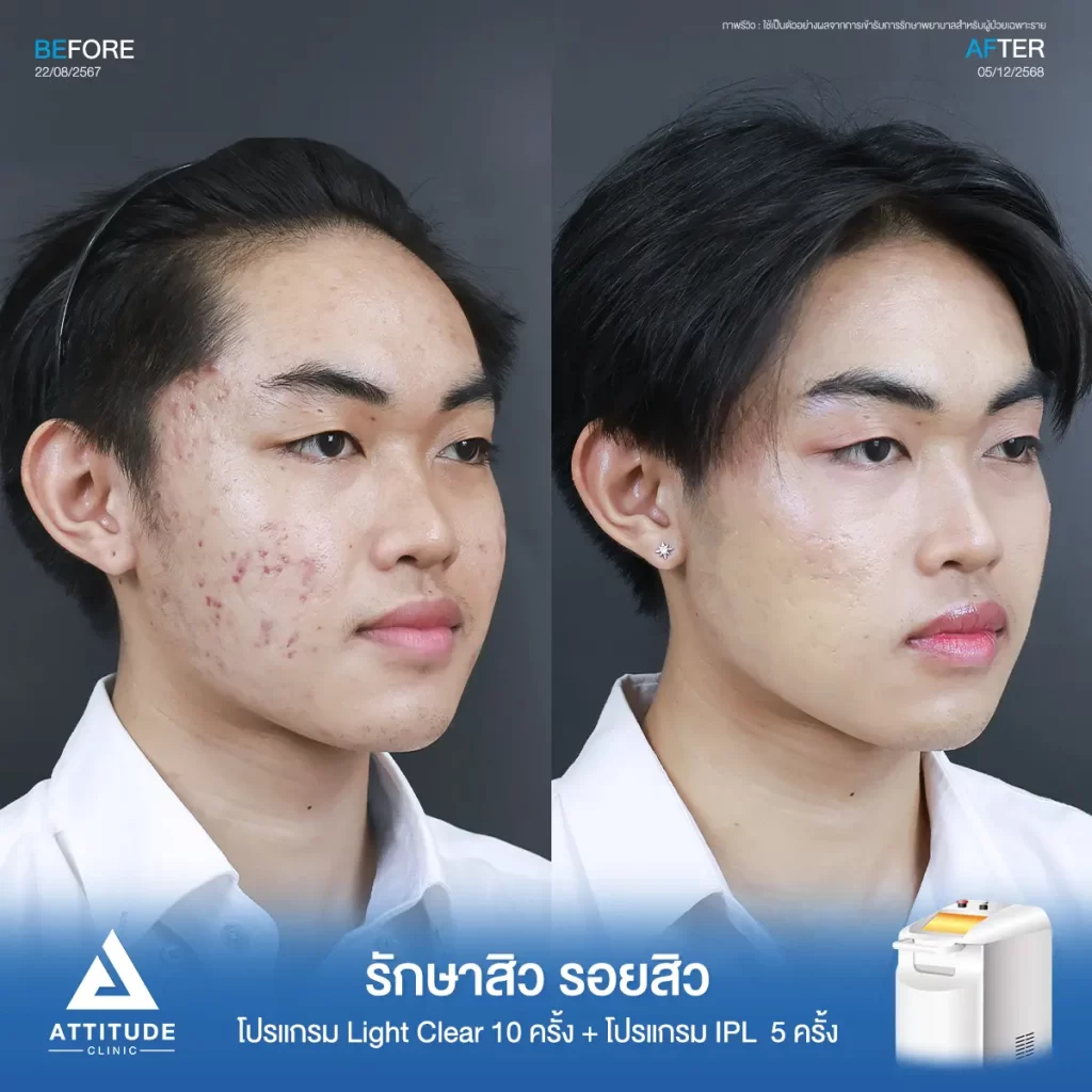รีวิวรักษาสิวรอยสิวพี่ศุภนิมิต โปรแกรม Light Clear จำนวน 10 ครั้ง และและโปรแกรม IPL จำนวน 5 ครั้ง ที่ Attitude Clinic
