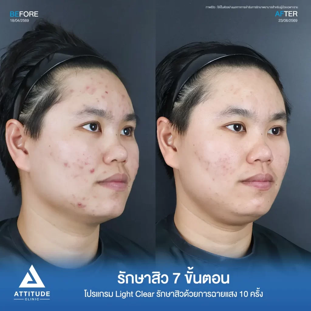 รีวิวรักษาสิวพี่มีน โปรแกรม Light Clear จำนวน 10 ครั้งที่ Attitude Clinic