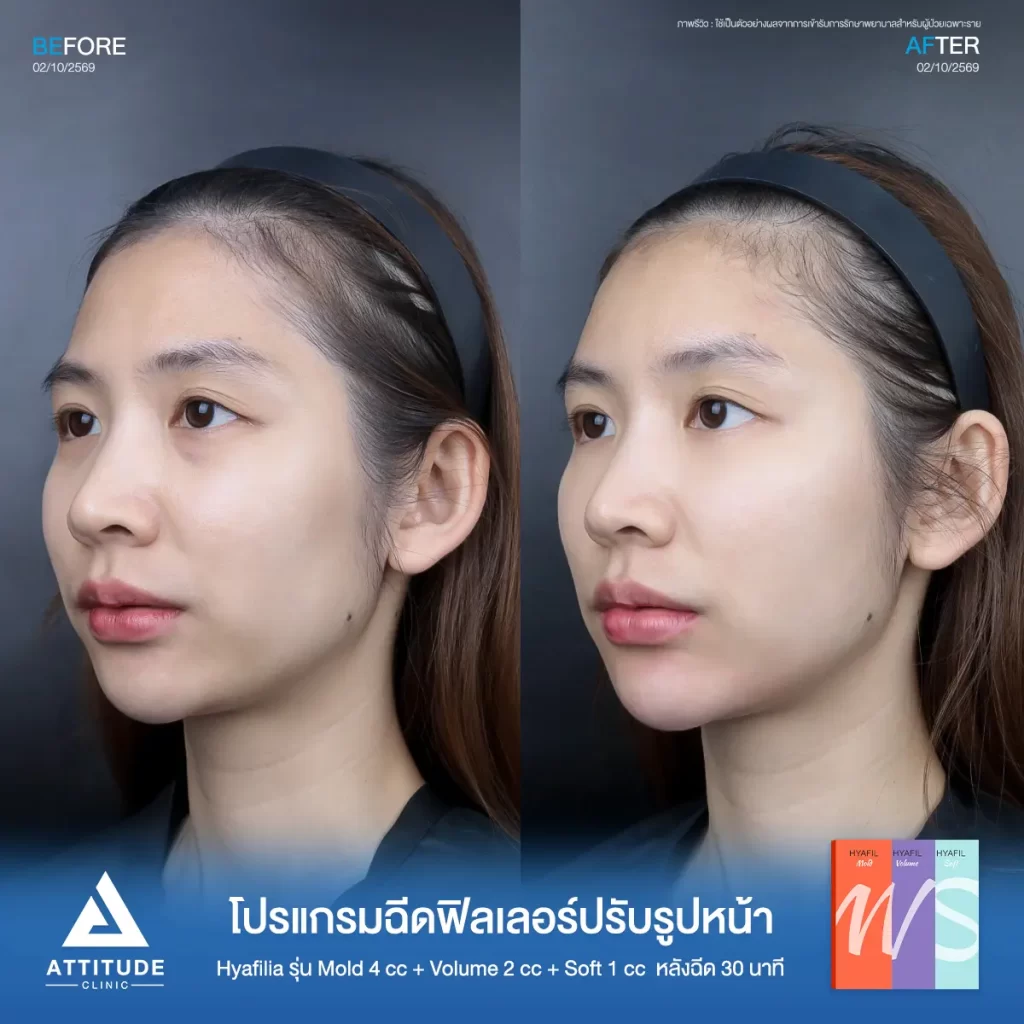 รีวิวโปรแกรมฉีดฟิลเลอร์พี่ฝัน Hya รุ่น S 1 cc รุ่น M 4 cc และรุ่น V 2 cc ปรับรูปหน้าที่ ATTITUDE CLINIC