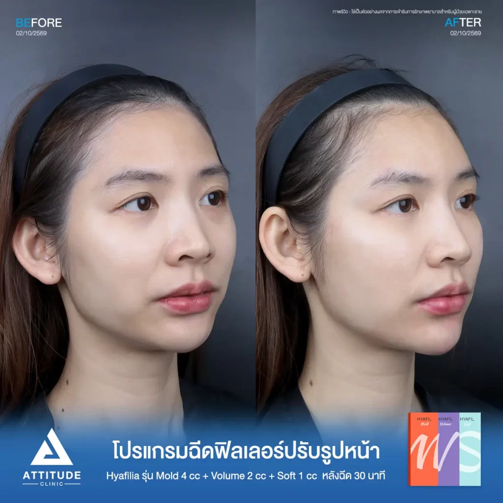 รีวิวโปรแกรมฉีดฟิลเลอร์พี่ฝัน Hya รุ่น S 1 cc รุ่น M 4 cc และรุ่น V 2 cc ปรับรูปหน้าที่ ATTITUDE CLINIC