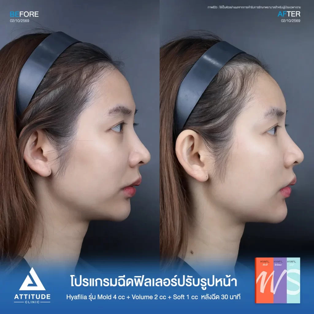 รีวิวโปรแกรมฉีดฟิลเลอร์พี่ฝัน Hya รุ่น S 1 cc รุ่น M 4 cc และรุ่น V 2 cc ปรับรูปหน้าที่ ATTITUDE CLINIC