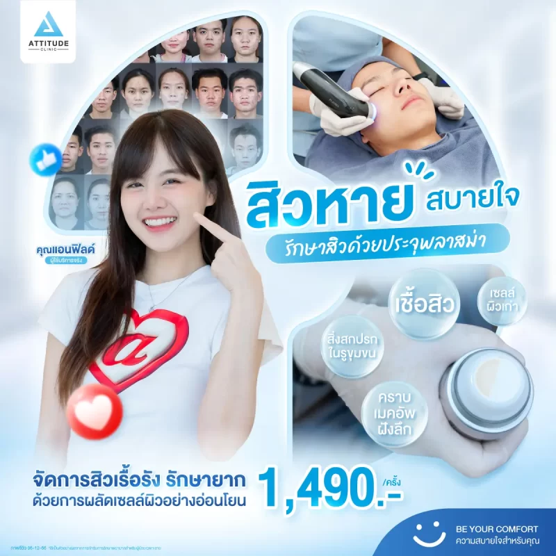 สิวหาย สบายใจ รักษาสิวด้วยประจุพลาสม่าเพียง 1,490.-