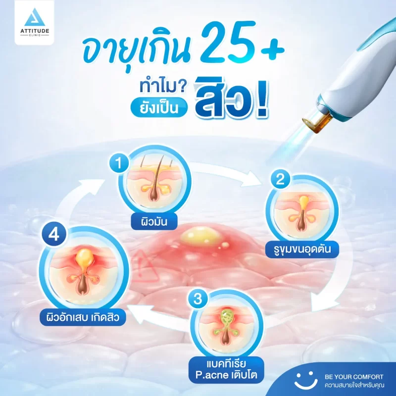 อายุ 25+ ทำไมยังเป็นสิวไม่เลิก ?!