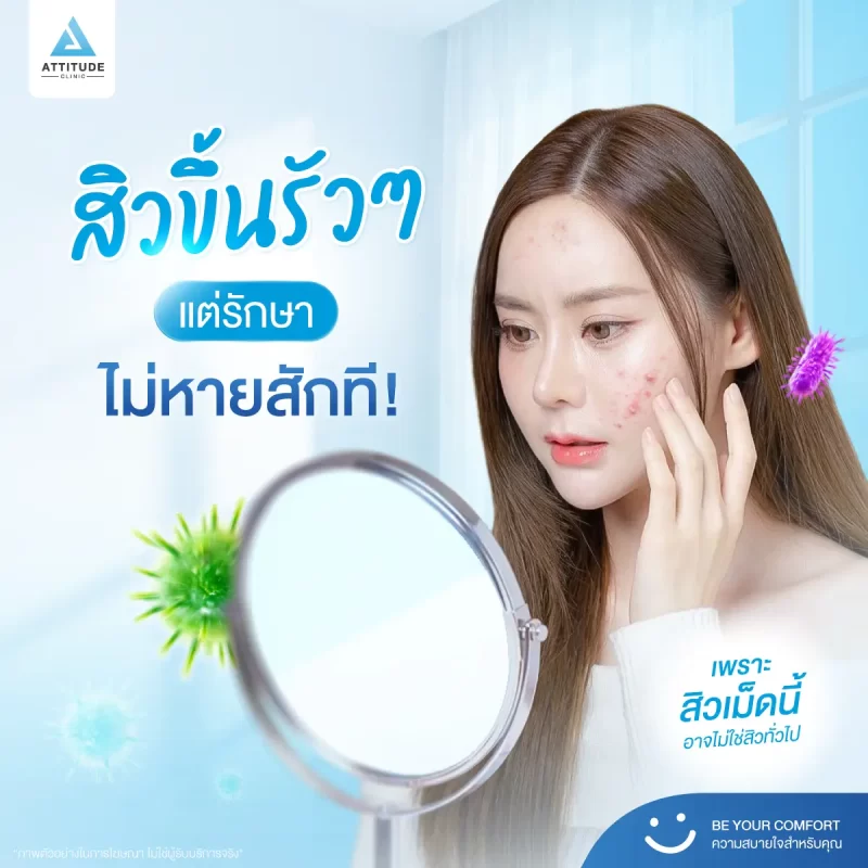 129-Content-(งานวิจัย-Album)-สิวเชื้อรา-1200x1200