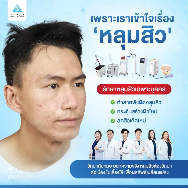 179-รวมโปรแกรมรักษาหลุมสิว_06
