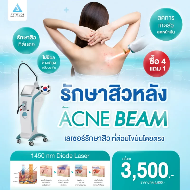 204-Neobeam-Laser-รักษาสิวหลัง_Mock_1200x1200px