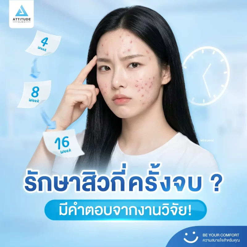 รักษาสิวกี่ครั้งหาย ? กี่ครั้งจบ ? งานวิจัยมีคำตอบ