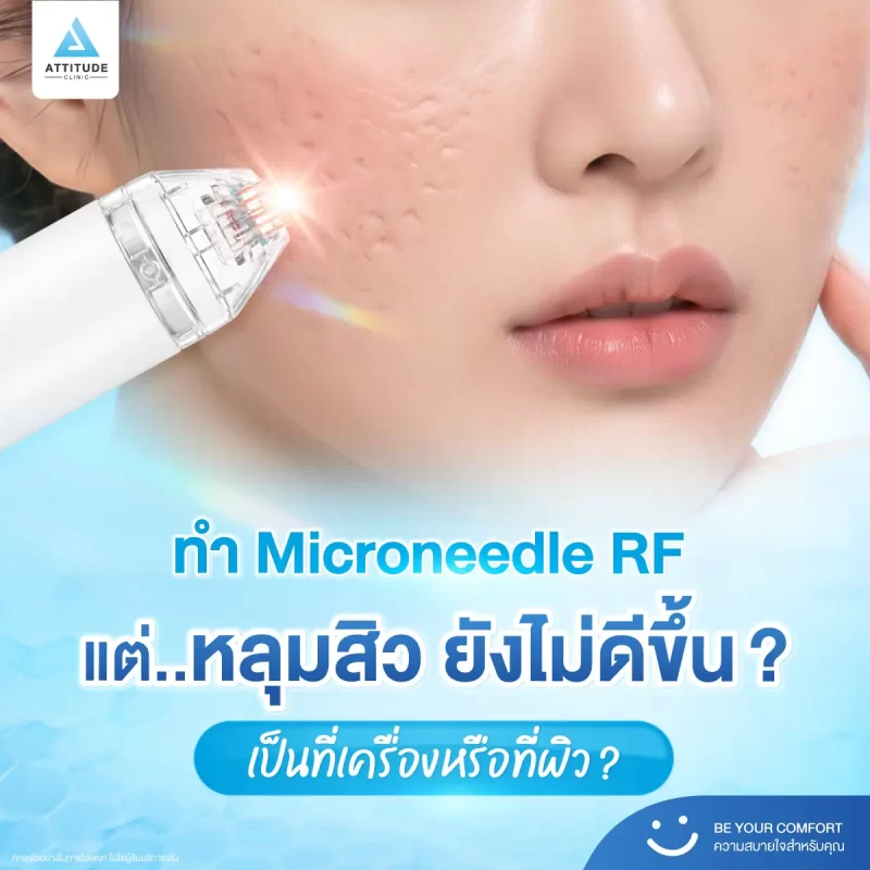 หลุมสิว ใครว่ารักษาเหมือนกัน! บางคนรักษาด้วยเทคโนโลยี Microneedle RF หลายครั้ง แต่หลุมสิวยังอยู่ เพราะอะไรกันแน่​ ?