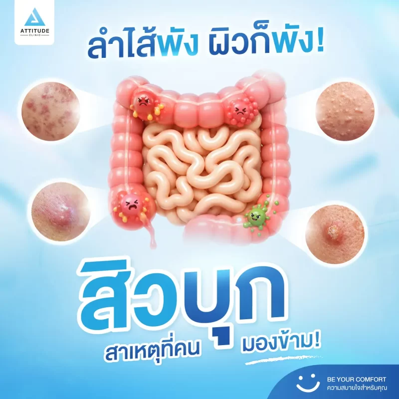 หยุดวงจรสิว แบบไม่ต้องจ่ายแพง เริ่มง่ายๆ แค่ดูแลลำไส้