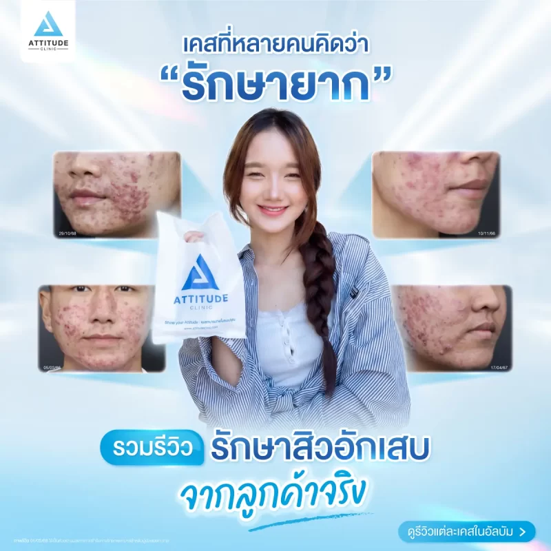 รวมรีวิวรักษาสิวอักเสบ ที่หลายคนเคยคิดว่า... "สิวแบบนี้รักษายาก"