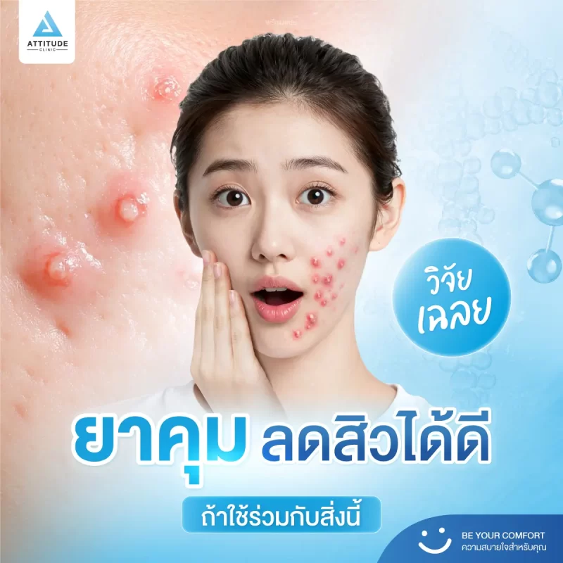 วิจัยเผยยาคุมกำเนิดช่วยลดสิวได้ ถ้าใช้ร่วมกับสิ่งนี้!