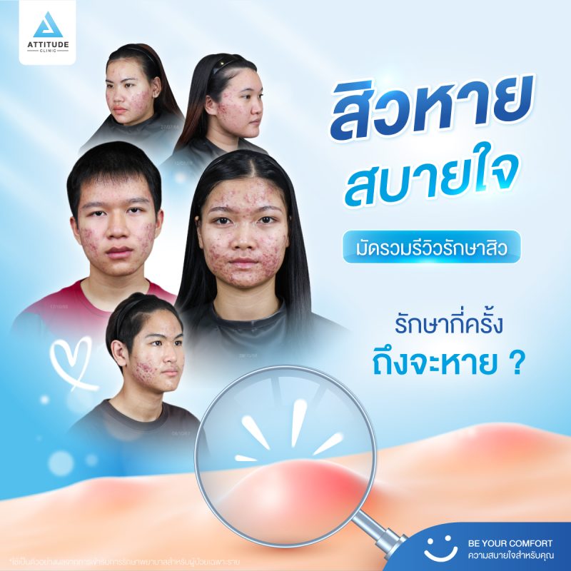 94-Content-(อัลบั้ม)-สิวหาย-สบายใจ-มัดรวมรีวิวรักษาสิว-1200x1200